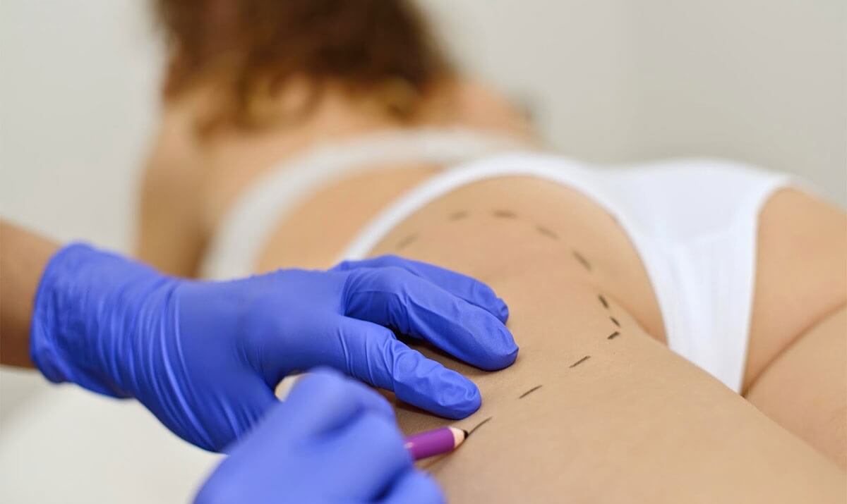 Intralipoterapia
